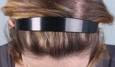 Before Hair Transplant&nbsp;Hair Thinning